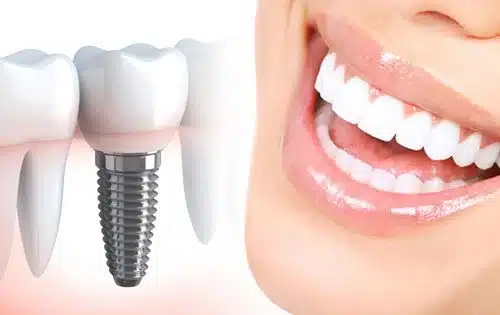 هزینه ایمپلنت دندان 15 dental-implant