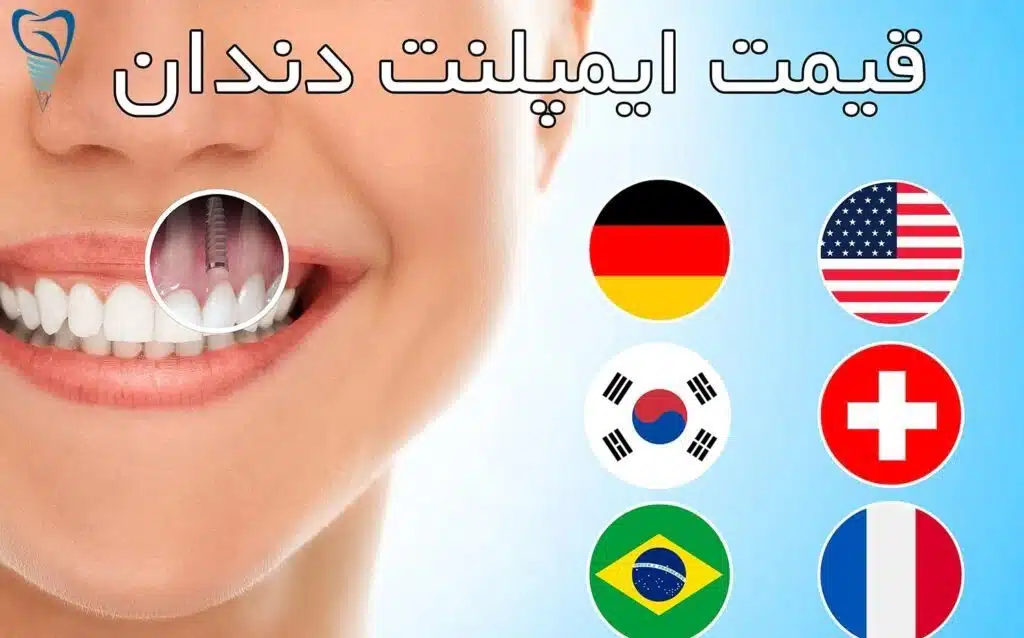 ایمپلنت دندان ارزان 10 ایمپلنت دندان ارزان